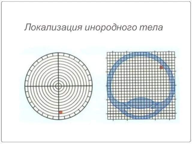 Локализация инородного тела