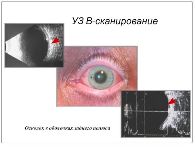 УЗ В-сканирование Осколок в оболочках заднего полюса