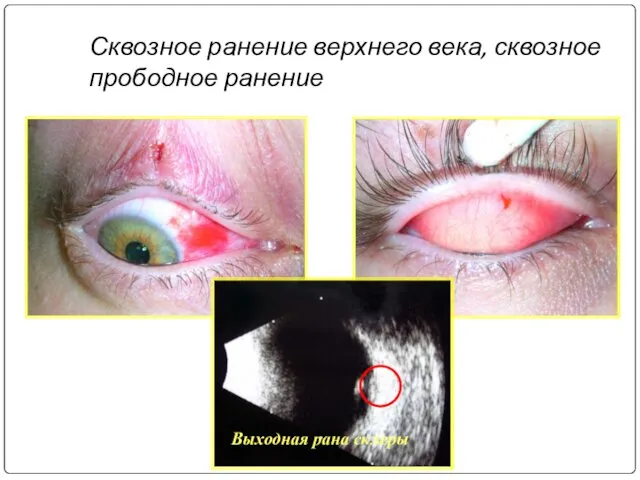 Сквозное ранение верхнего века, сквозное прободное ранение Выходная рана склеры