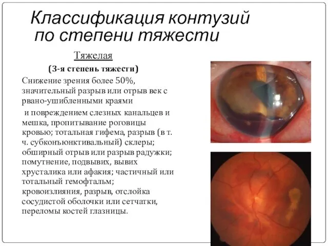 Классификация контузий по степени тяжести Тяжелая (3-я степень тяжести) Снижение зрения