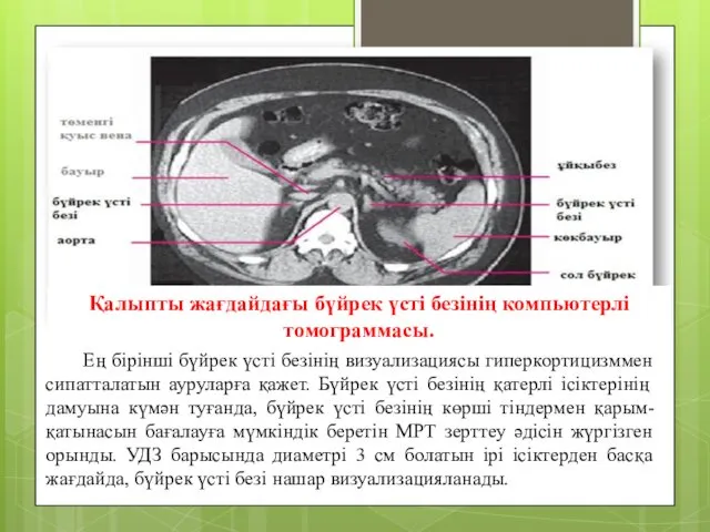 Қалыпты жағдайдағы бүйрек үсті безінің компьютерлі томограммасы. Ең бірінші бүйрек үсті