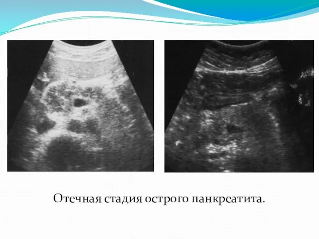 Отечная стадия острого панкреатита.