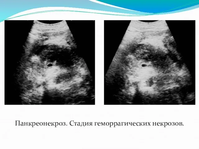 Панкреонекроз. Стадия геморрагических некрозов.