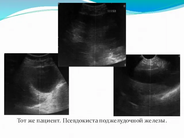 Тот же пациент. Псевдокиста поджелудочной железы.