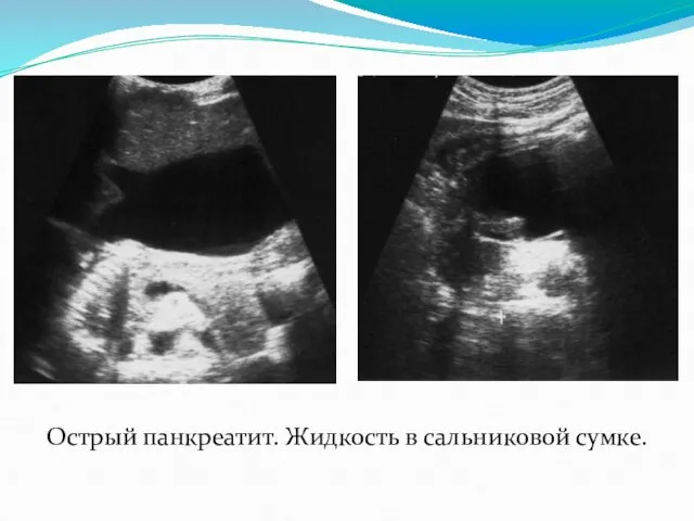 Острый панкреатит. Жидкость в сальниковой сумке.