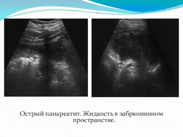 Острый панкреатит. Жидкость в забрюшинном пространстве.