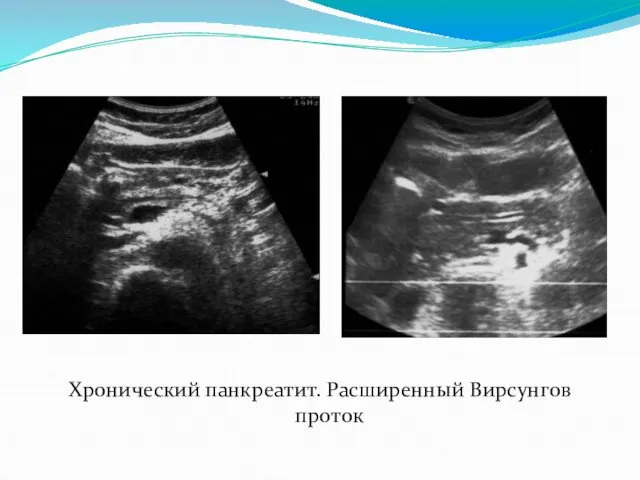 Хронический панкреатит. Расширенный Вирсунгов проток