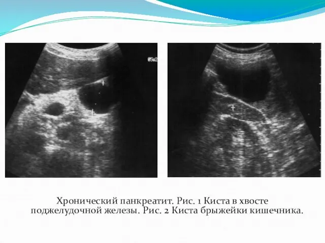 Хронический панкреатит. Рис. 1 Киста в хвосте поджелудочной железы. Рис. 2 Киста брыжейки кишечника.