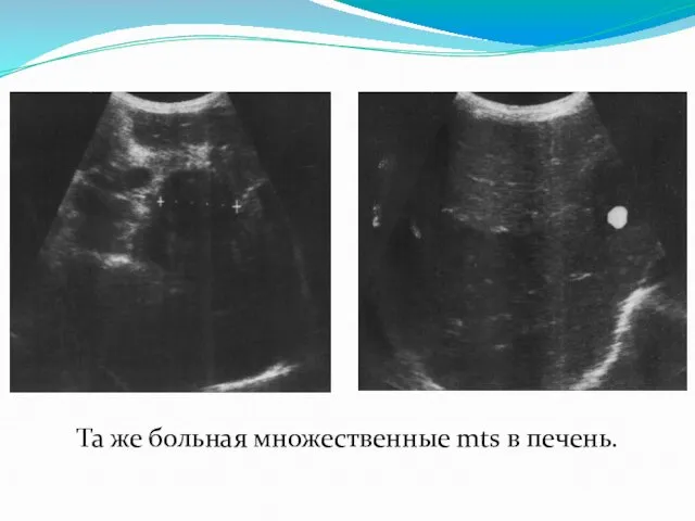 Та же больная множественные mts в печень.