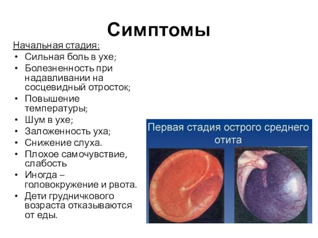 Симптомы Начальная стадия: Сильная боль в ухе; Болезненность при надавливании на