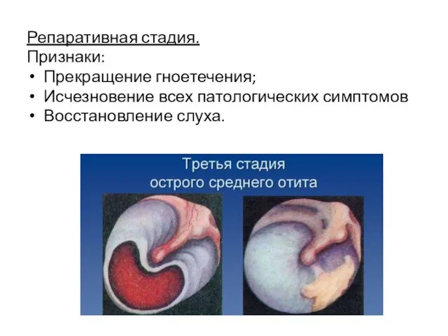 Репаративная стадия. Признаки: Прекращение гноетечения; Исчезновение всех патологических симптомов Восстановление слуха.