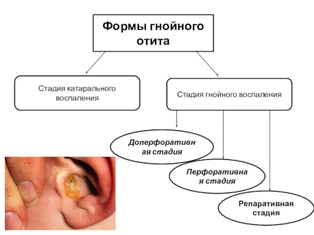 Формы гнойного отита Стадия катарального воспаления Стадия гнойного воспаления Доперфоративная стадия Перфоративная стадия Репаративная стадия