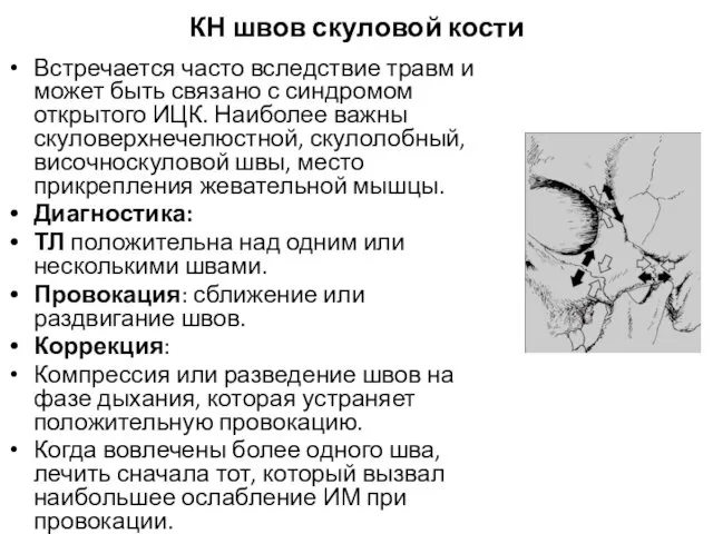 КН швов скуловой кости Встречается часто вследствие травм и может быть