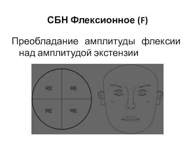 Преобладание амплитуды флексии над амплитудой экстензии СБН Флексионное (F)