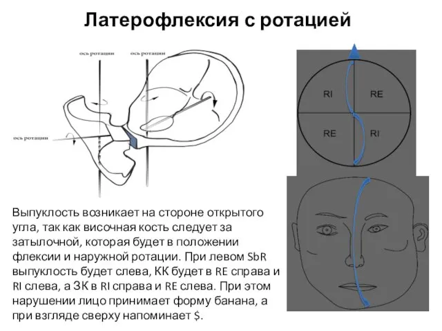 Латерофлексия с ротацией Выпуклость возникает на стороне открытого угла, так как