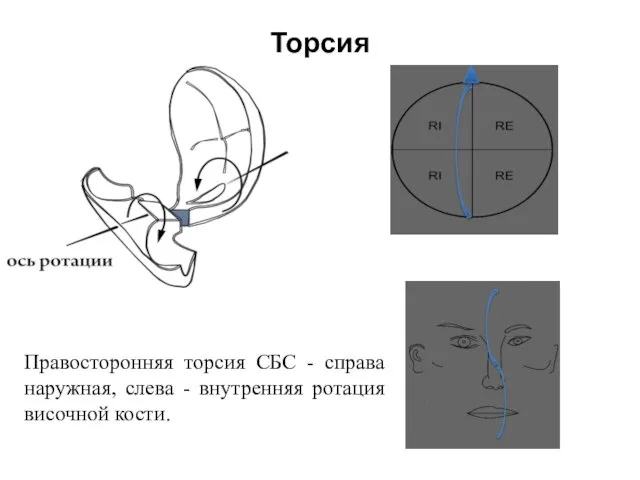 Торсия Правосторонняя торсия СБС - справа наружная, слева - внутренняя ротация височной кости.