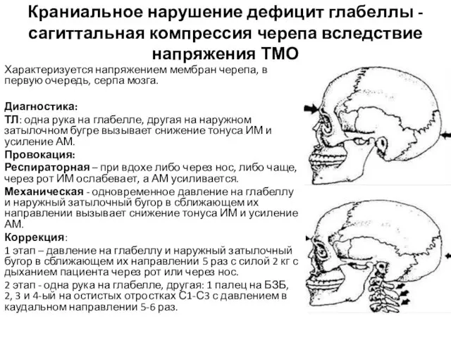 Краниальное нарушение дефицит глабеллы - сагиттальная компрессия черепа вследствие напряжения ТМО