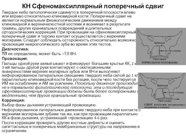 КН Сфеномаксиллярный поперечный сдвиг Твердое небо патологически сдвинуто в поперечной плоскости