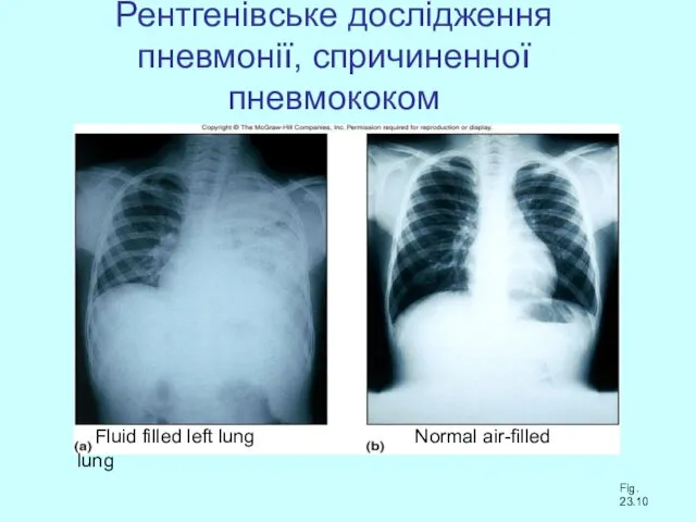 Рентгенівське дослідження пневмонії, спричиненної пневмококом Fluid filled left lung Normal air-filled lung Fig. 23.10