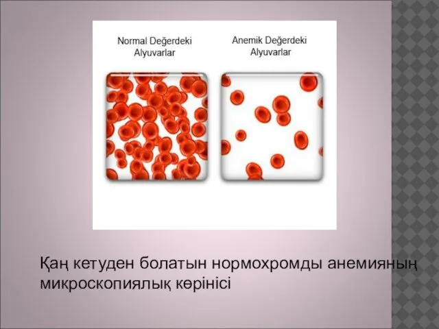 Қаң кетуден болатын нормохромды анемияның микроскопиялық көрінісі