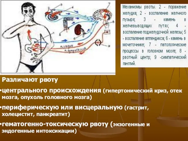 Различают рвоту центрального происхождения (гипертонический криз, отек мозга, опухоль головного мозга)