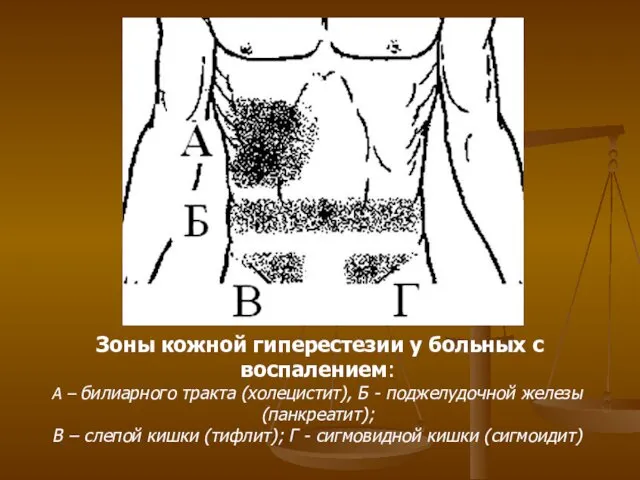 Зоны кожной гиперестезии у больных с воспалением: А – билиарного тракта