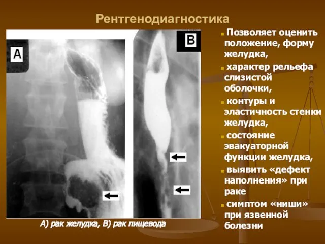 Рентгенодиагностика А) рак желудка, В) рак пищевода Позволяет оценить положение, форму