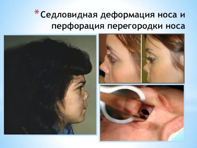 Седловидная деформация носа и перфорация перегородки носа