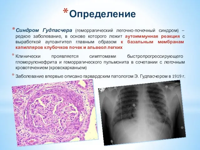 Определение Синдром Гудпасчера (геморрагический легочно-почечный синдром) – редкое заболевание, в основе