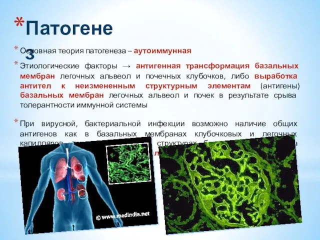 Патогенез Основная теория патогенеза – аутоиммунная Этиологические факторы → антигенная трансформация