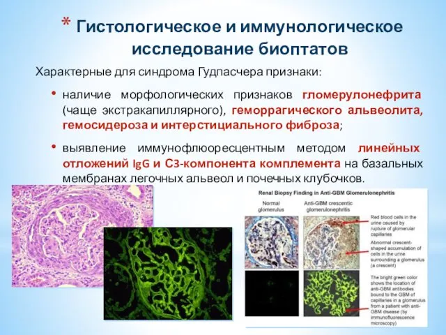 Гистологическое и иммунологическое исследование биоптатов Характерные для синдрома Гудпасчера признаки: наличие