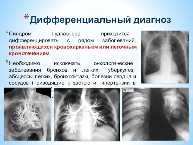 Дифференциальный диагноз Синдром Гудпасчера приходится дифференцировать с рядом заболеваний, проявляющихся кровохарканьем