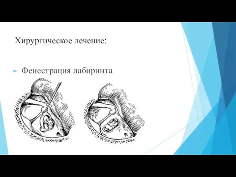 Хирургическое лечение: Фенестрация лабиринта