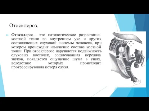 Отосклероз. Отосклероз – это патологическое разрастание костной ткани во внутреннем ухе