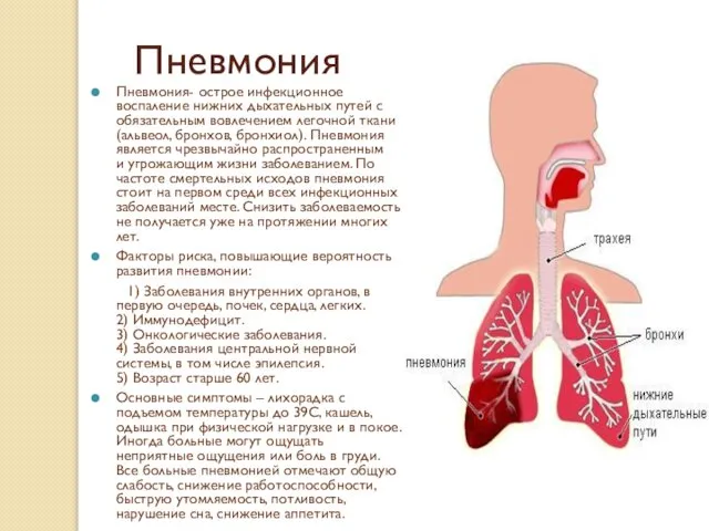 Пневмония- острое инфекционное воспаление нижних дыхательных путей с обязательным вовлечением легочной