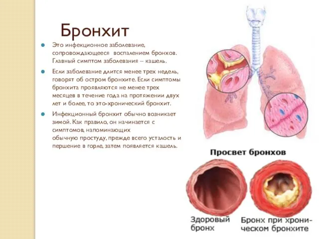 Бронхит Это инфекционное заболевание, сопровождающееся воспалением бронхов. Главный симптом заболевания –