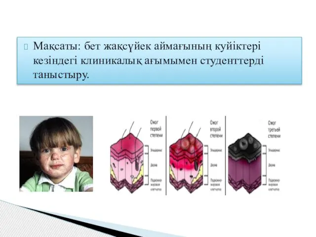 Мақсаты: бет жақсүйек аймағының куйіктері кезіндегі клиникалық ағымымен студенттерді таныстыру.