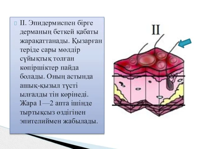 II. Эпидермиспен бірге дерманың беткей қабаты жарақаттанады. Қызарған теріде сары мөлдір