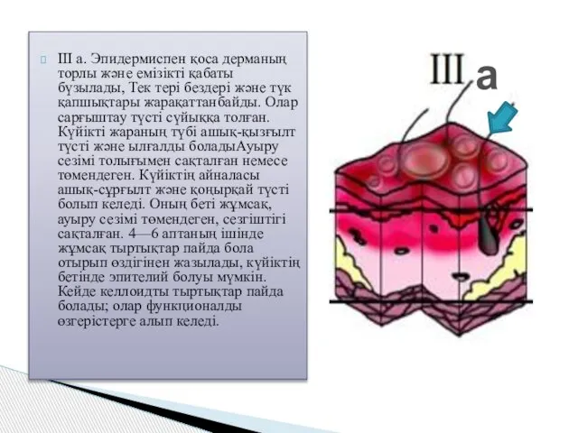 III а. Эпидермиспен қоса дерманың торлы және емізікті қабаты бүзылады, Тек