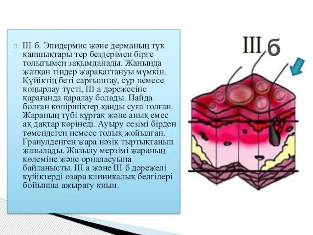 III б. Эпидермис және дерманың түк қапшықтары тер бездерімен бірге толығымен