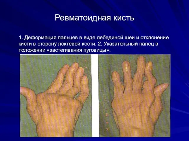 Ревматоидная кисть 1. Деформация пальцев в виде лебединой шеи и отклонение
