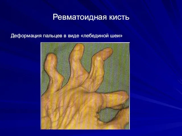 Ревматоидная кисть Деформация пальцев в виде «лебединой шеи»