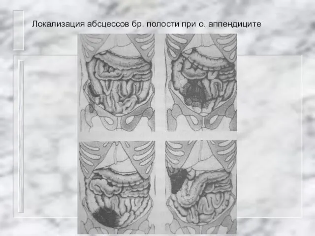 Локализация абсцессов бр. полости при о. аппендиците