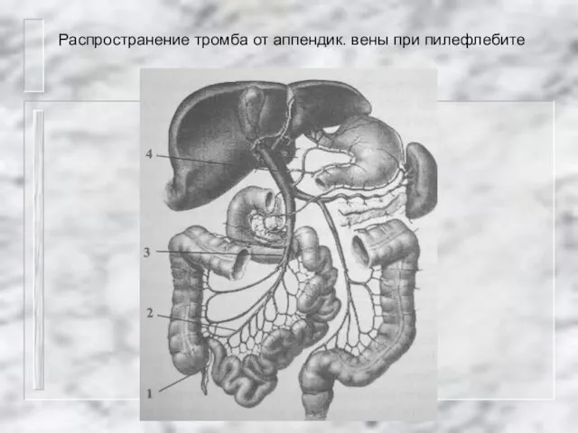 Распространение тромба от аппендик. вены при пилефлебите