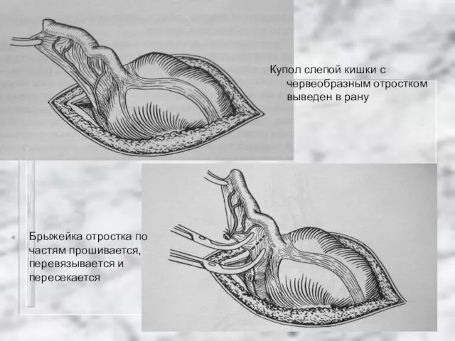 Купол слепой кишки с червеобразным отростком выведен в рану Брыжейка отростка