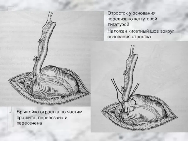 Брыжейка отростка по частям прошита, перевязана и пересечена Отросток у основания