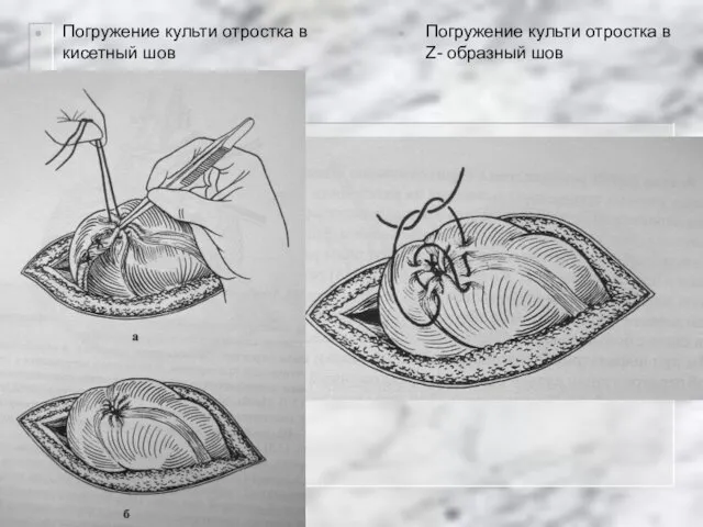 Погружение культи отростка в Z- образный шов Погружение культи отростка в кисетный шов