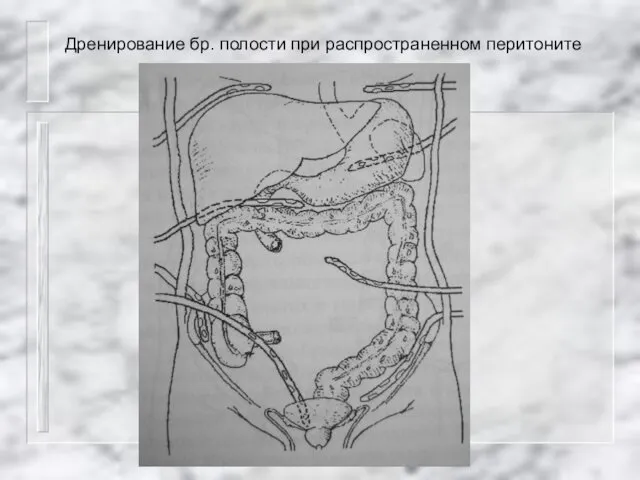 Дренирование бр. полости при распространенном перитоните