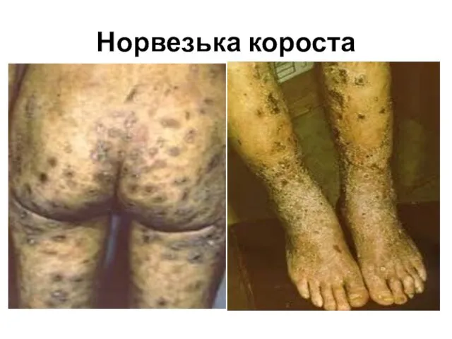 Норвезька короста