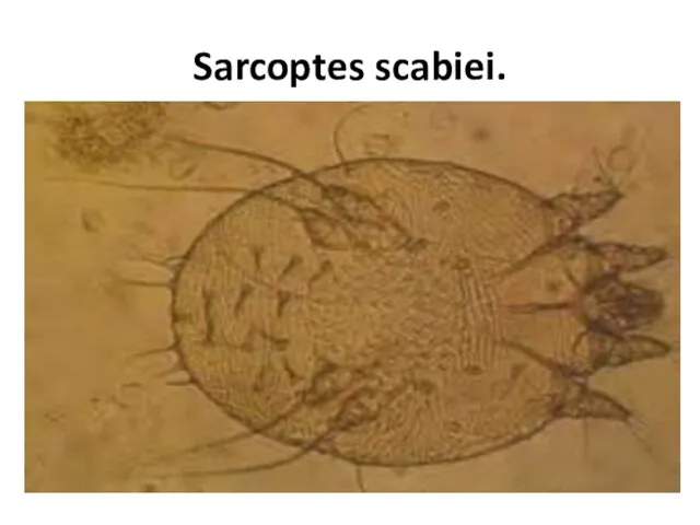 Sarcoptes scabiei.